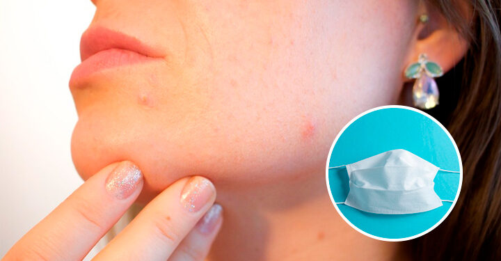 Maskne: así puedes combatir el acné provocado por el uso de cubrebocas