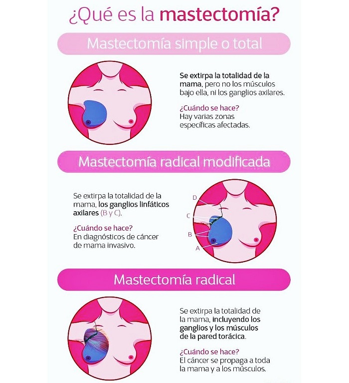 ¿Cuánto cuesta atender el cáncer de mama en México?