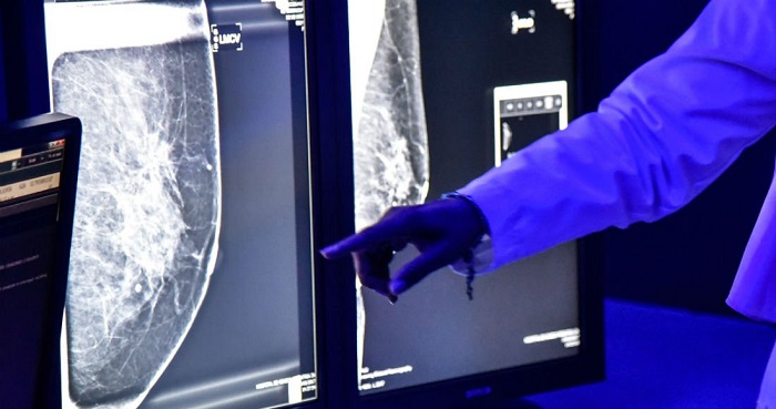 ¿Los implantes de senos producen cáncer?