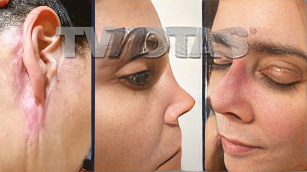 Así quedó Dorismar tras rinoplastia